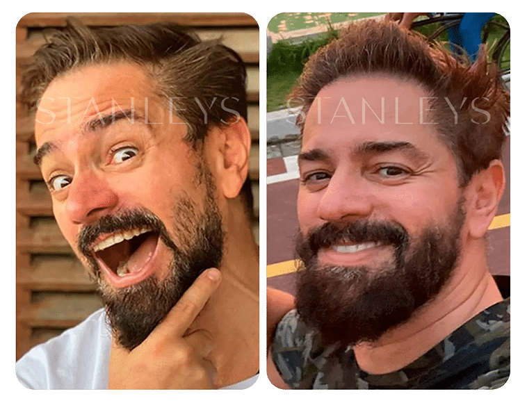 Antes e Depois_LP 20