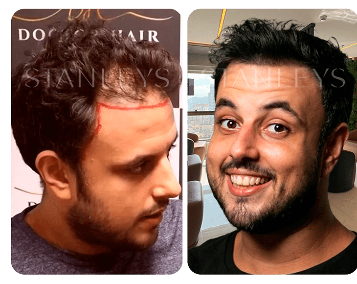 Antes e Depois_LP 21