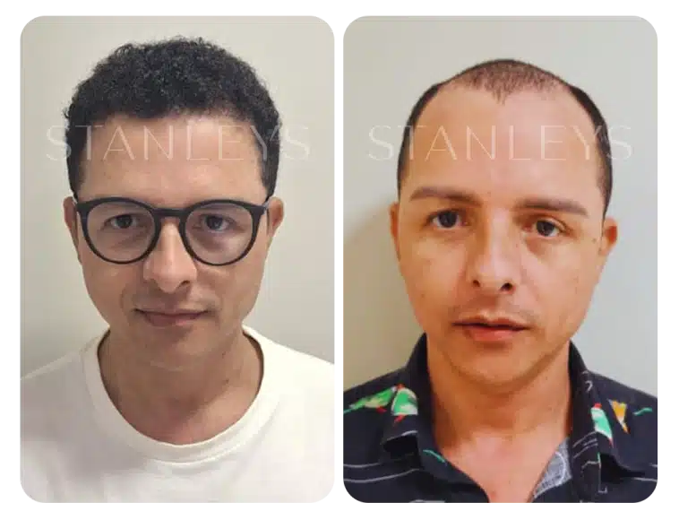 antes_e_depois_lp_02_2x