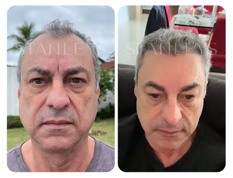 antes_e_depois_lp_05_2x