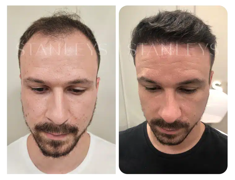 antes_e_depois_lp_09_2x